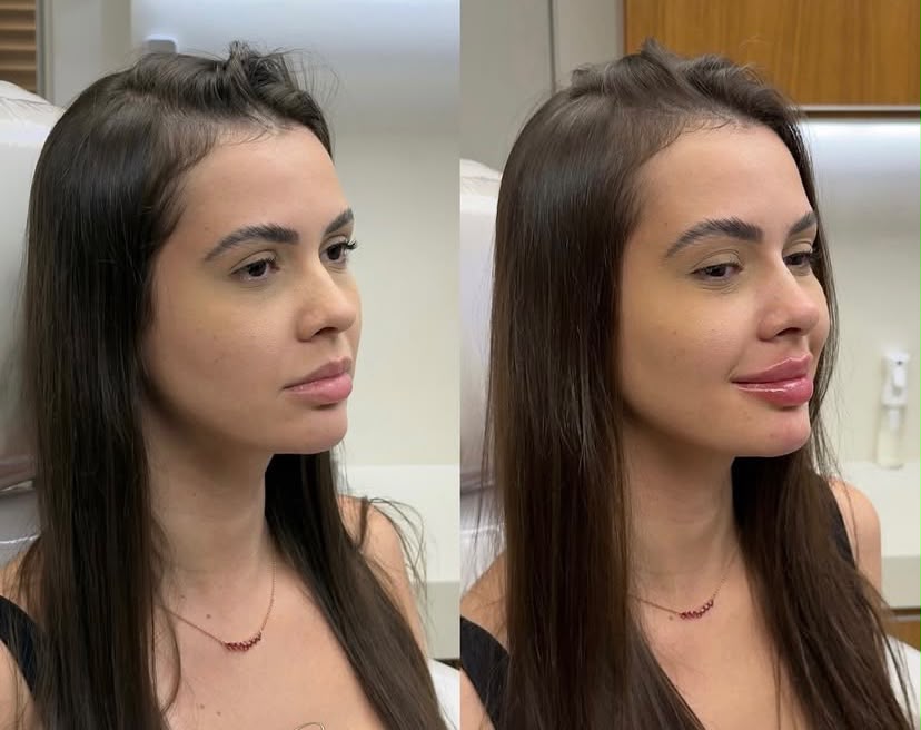 Harmonização Facial