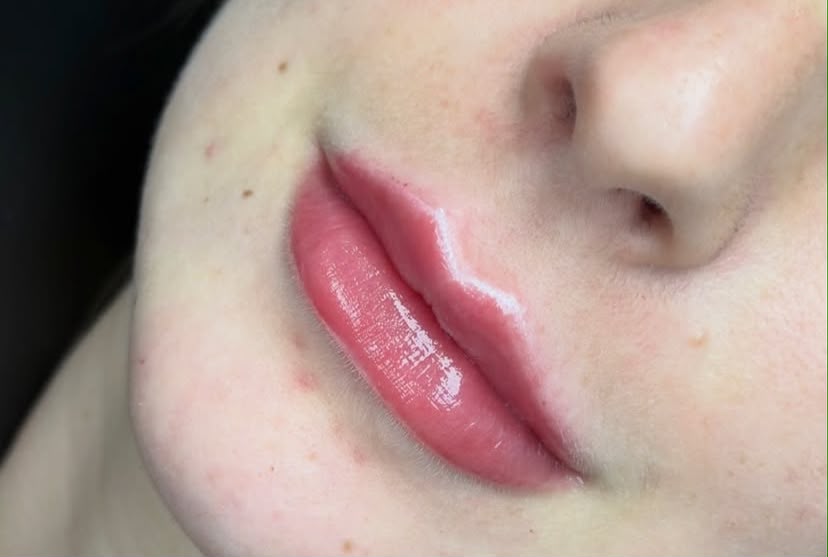 Preenchimento Labial